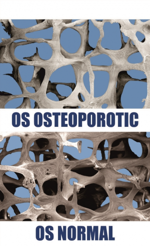 os osteoporotic